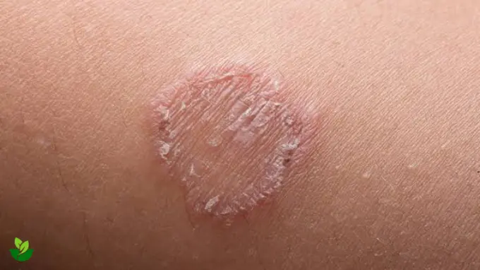 ayurvedic home remedy desi treatment for ringworm
