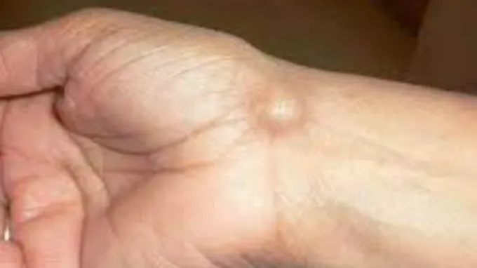 lumps in body ayurved tips